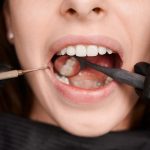 dental crowns