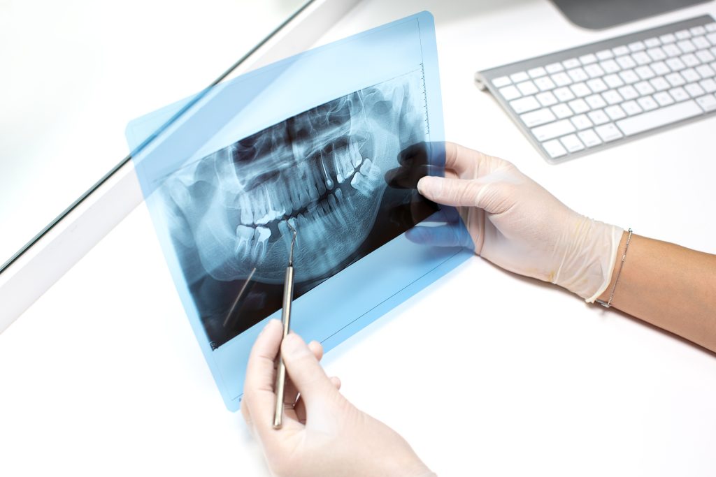 Dental X-Rays
