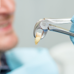 Tooth Extractions in Plano TX