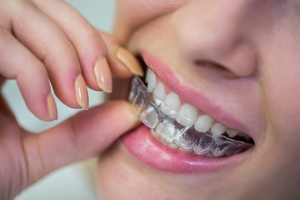 invisalign-clear-aligners-in-plano-tx