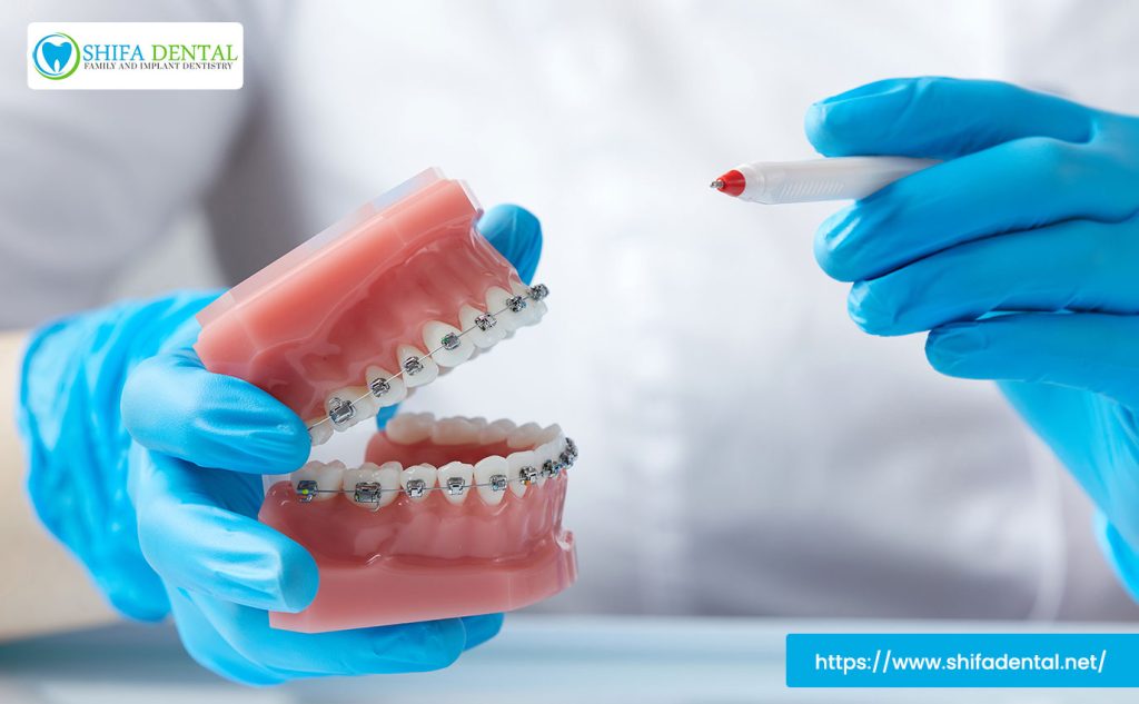 metal-braces-plano