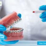 metal-braces-plano