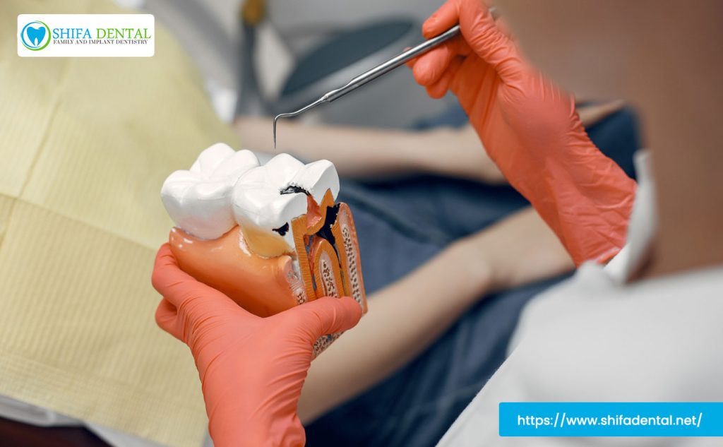affordable-root-canal-plano
