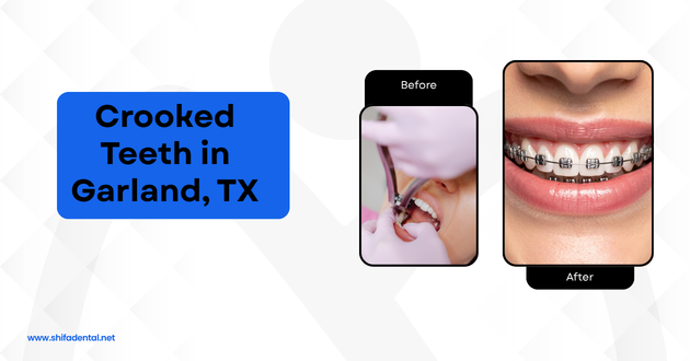 Crooked Teeth in Garland, TX