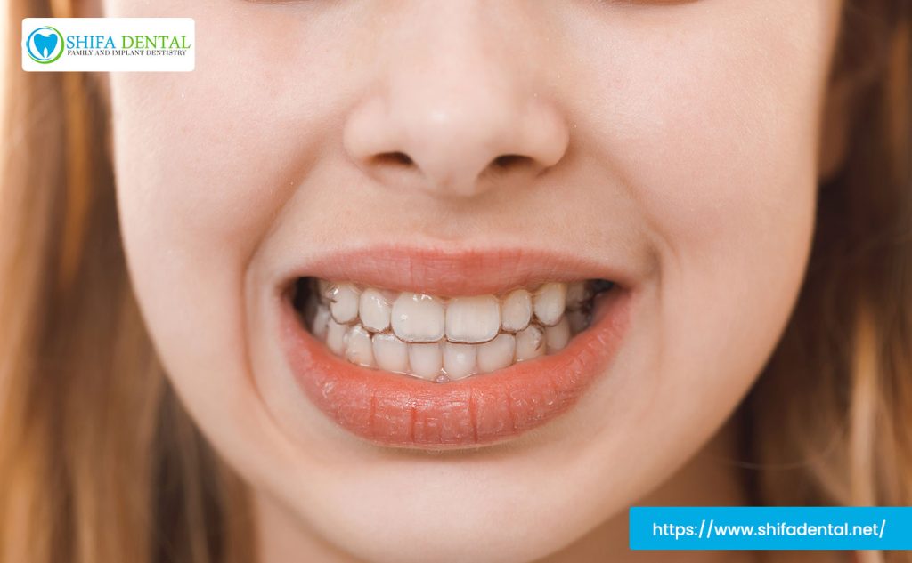 what is an overbite